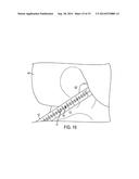 METHODS, SYSTEMS, AND DEVICES FOR GAUGING A BONE TUNNEL diagram and image