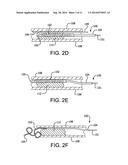 RECANALIZATION DEVICE diagram and image