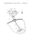 Surgical Instrument For Dispensing Tacks And Solution diagram and image