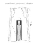 VASCULAR PLAQUE REMOVAL SYSTEMS, DEVICES, AND METHODS diagram and image