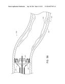 VASCULAR PLAQUE REMOVAL SYSTEMS, DEVICES, AND METHODS diagram and image