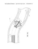 VASCULAR PLAQUE REMOVAL SYSTEMS, DEVICES, AND METHODS diagram and image