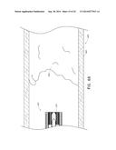 VASCULAR PLAQUE REMOVAL SYSTEMS, DEVICES, AND METHODS diagram and image