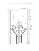 VASCULAR PLAQUE REMOVAL SYSTEMS, DEVICES, AND METHODS diagram and image