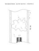 VASCULAR PLAQUE REMOVAL SYSTEMS, DEVICES, AND METHODS diagram and image