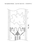 VASCULAR PLAQUE REMOVAL SYSTEMS, DEVICES, AND METHODS diagram and image