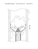 VASCULAR PLAQUE REMOVAL SYSTEMS, DEVICES, AND METHODS diagram and image