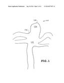 SHAPE-MEMORY POLYMER FOAM DEVICE FOR TREATING ANEURYSMS diagram and image
