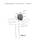 SHAPE-MEMORY POLYMER FOAM DEVICE FOR TREATING ANEURYSMS diagram and image