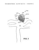 SHAPE-MEMORY POLYMER FOAM DEVICE FOR TREATING ANEURYSMS diagram and image