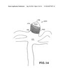 SHAPE-MEMORY POLYMER FOAM DEVICE FOR TREATING ANEURYSMS diagram and image