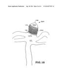 SHAPE-MEMORY POLYMER FOAM DEVICE FOR TREATING ANEURYSMS diagram and image