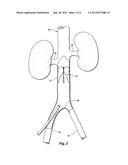 REMOVABLE VENA CAVA FILTER HAVING PRIMARY AND SECONDARY STRUTS diagram and image