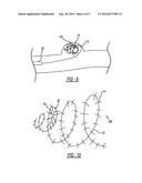 EMBOLIZATION COIL WITH BARBED FIBER diagram and image