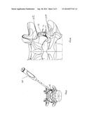 PEDICLE-BASED CONSTRUCT FACET JOINT FIXATION DEVICE diagram and image