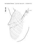 BONE REPAIR SYSTEM, KIT AND METHOD diagram and image