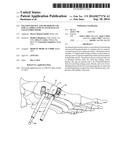 FIXATION DEVICE AND METHOD OF USE FOR A LAPIDUS-TYPE PLANTAR HALLUX VALGUS     PROCEDURE diagram and image