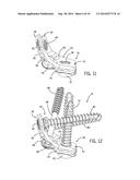 FIXATION DEVICE AND METHOD OF USE FOR A LAPIDUS-TYPE PLANTAR HALLUX VALGUS     PROCEDURE diagram and image