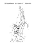 FIXATION DEVICE AND METHOD OF USE FOR A LAPIDUS-TYPE PLANTAR HALLUX VALGUS     PROCEDURE diagram and image