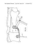 FIXATION DEVICE AND METHOD OF USE FOR A LAPIDUS-TYPE PLANTAR HALLUX VALGUS     PROCEDURE diagram and image