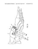 FIXATION DEVICE AND METHOD OF USE FOR A LAPIDUS-TYPE PLANTAR HALLUX VALGUS     PROCEDURE diagram and image