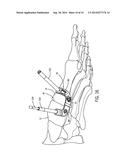 FIXATION DEVICE AND METHOD OF USE FOR A LAPIDUS-TYPE PLANTAR HALLUX VALGUS     PROCEDURE diagram and image