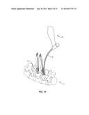 SURGICAL IMPLANT SYSTEM AND METHOD diagram and image