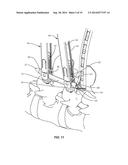 SURGICAL IMPLANT SYSTEM AND METHOD diagram and image