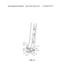 SURGICAL IMPLANT SYSTEM AND METHOD diagram and image