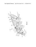 SURGICAL IMPLANT SYSTEM AND METHOD diagram and image