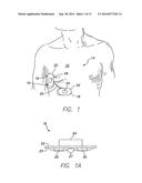 EXTERNALLY-SECURED MEDICAL DEVICE diagram and image