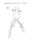 EXTENSION FOR ILIAC BRANCH DELIVERY DEVICE AND METHODS OF USING THE SAME diagram and image