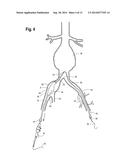 EXTENSION FOR ILIAC BRANCH DELIVERY DEVICE AND METHODS OF USING THE SAME diagram and image