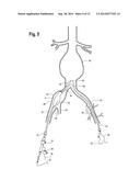 EXTENSION FOR ILIAC BRANCH DELIVERY DEVICE AND METHODS OF USING THE SAME diagram and image