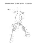 EXTENSION FOR ILIAC BRANCH DELIVERY DEVICE AND METHODS OF USING THE SAME diagram and image