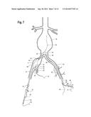 EXTENSION FOR ILIAC BRANCH DELIVERY DEVICE AND METHODS OF USING THE SAME diagram and image