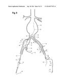 EXTENSION FOR ILIAC BRANCH DELIVERY DEVICE AND METHODS OF USING THE SAME diagram and image