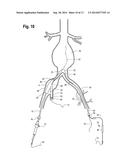 EXTENSION FOR ILIAC BRANCH DELIVERY DEVICE AND METHODS OF USING THE SAME diagram and image