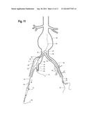 EXTENSION FOR ILIAC BRANCH DELIVERY DEVICE AND METHODS OF USING THE SAME diagram and image