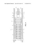 Distal Capture Device for a Self-Expanding Stent diagram and image