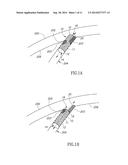 OBLIQUE STENT diagram and image