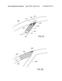 OBLIQUE STENT diagram and image