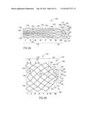 OBLIQUE STENT diagram and image