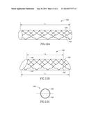 OBLIQUE STENT diagram and image