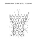 RADIOPAQUE TRANSCATHETER VALVE AND ANATOMICAL MARKERS diagram and image