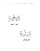 CUFF CONFIGURATIONS FOR PROSTHETIC HEART VALVE diagram and image