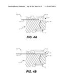 Paravalvular Leak Occlusion Device for Self-Expanding Heart Valves diagram and image