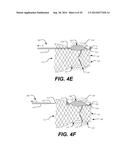 Paravalvular Leak Occlusion Device for Self-Expanding Heart Valves diagram and image