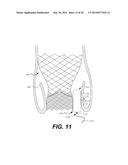 Paravalvular Leak Occlusion Device for Self-Expanding Heart Valves diagram and image