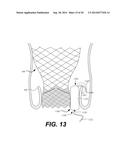 Paravalvular Leak Occlusion Device for Self-Expanding Heart Valves diagram and image